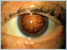 Начальная катаракта
