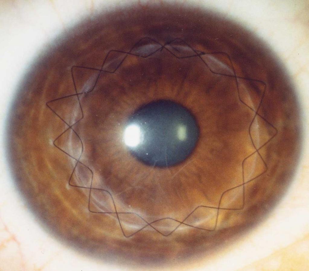 Глаз после операции