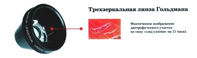 Линза гольдмана. Линза Гольдмана строение. Линза Гольдмана обследование. Осмотр периферии глазного дна трехзеркальной линзой Гольдмана. Биомикроскопия глаза с линзой Гольдмана.